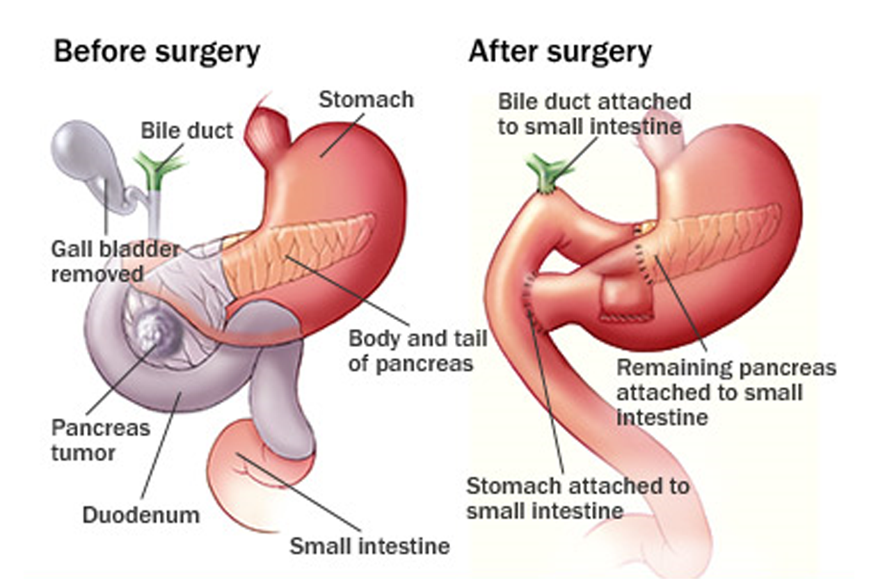 laparoscopic gall bladder surgery