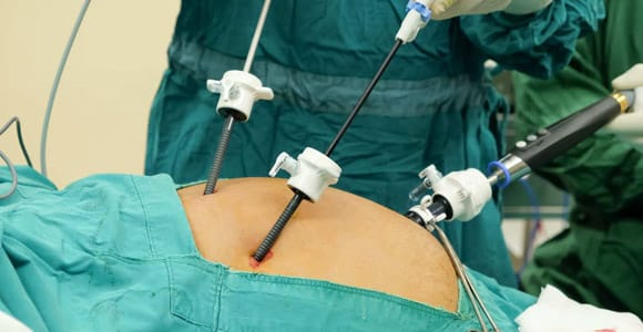 Laparoscopic Gall Bladder Surgery