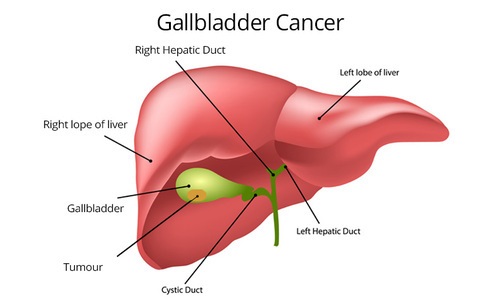 Best Gallbladder Surgeon