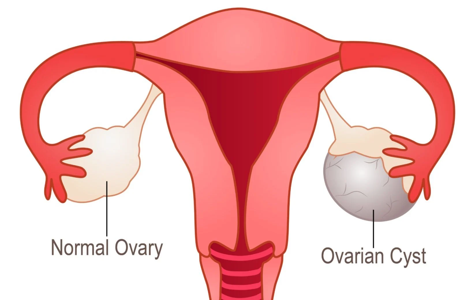 Ovarian Cyst Surgery