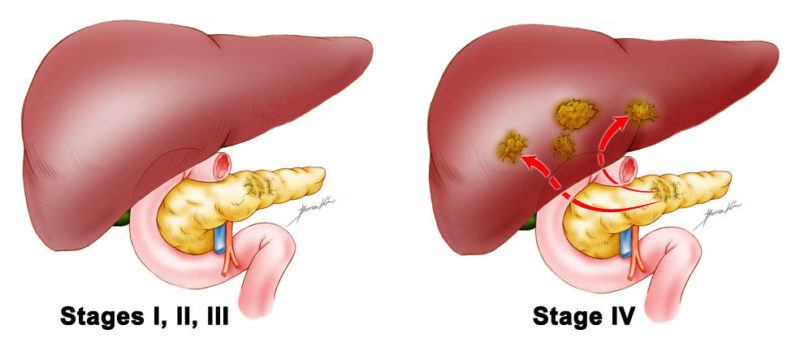 Pancreas Cancer Treatment