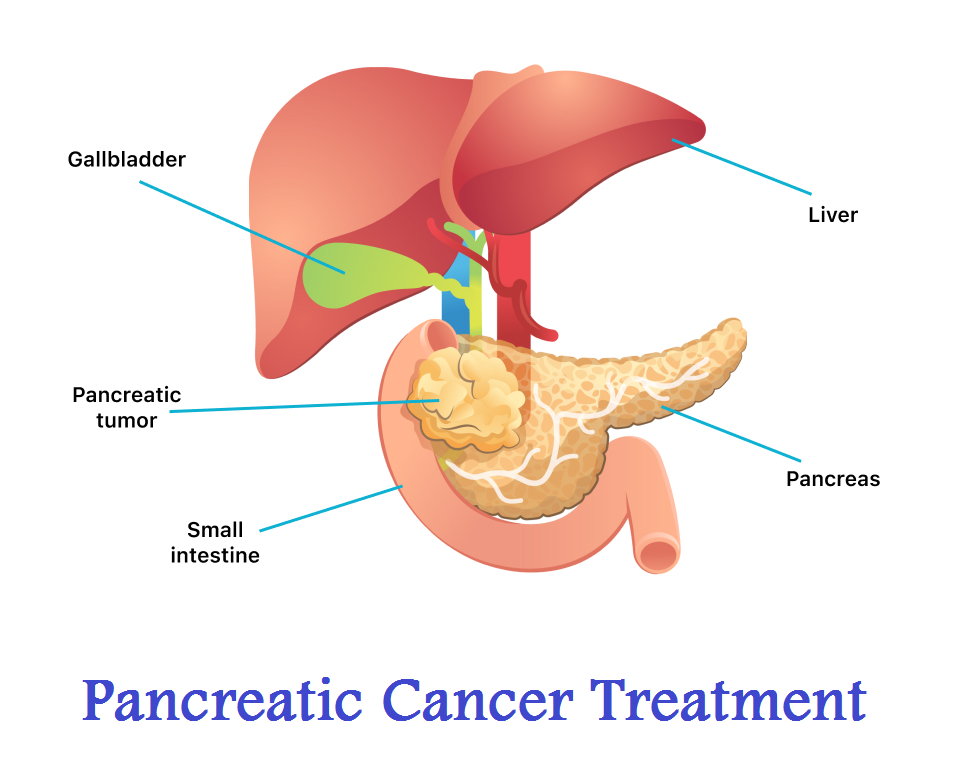 PANCREATIC CANCER TREATMENT CLINIC