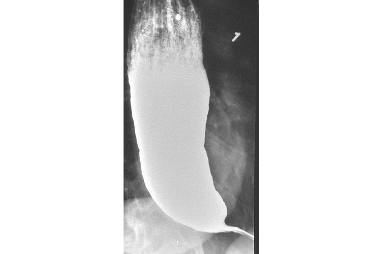 Рентгенологическая картина ахалазии пищевода