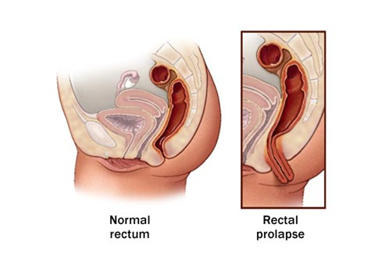 Laparoscopy For Rectal Prolapse